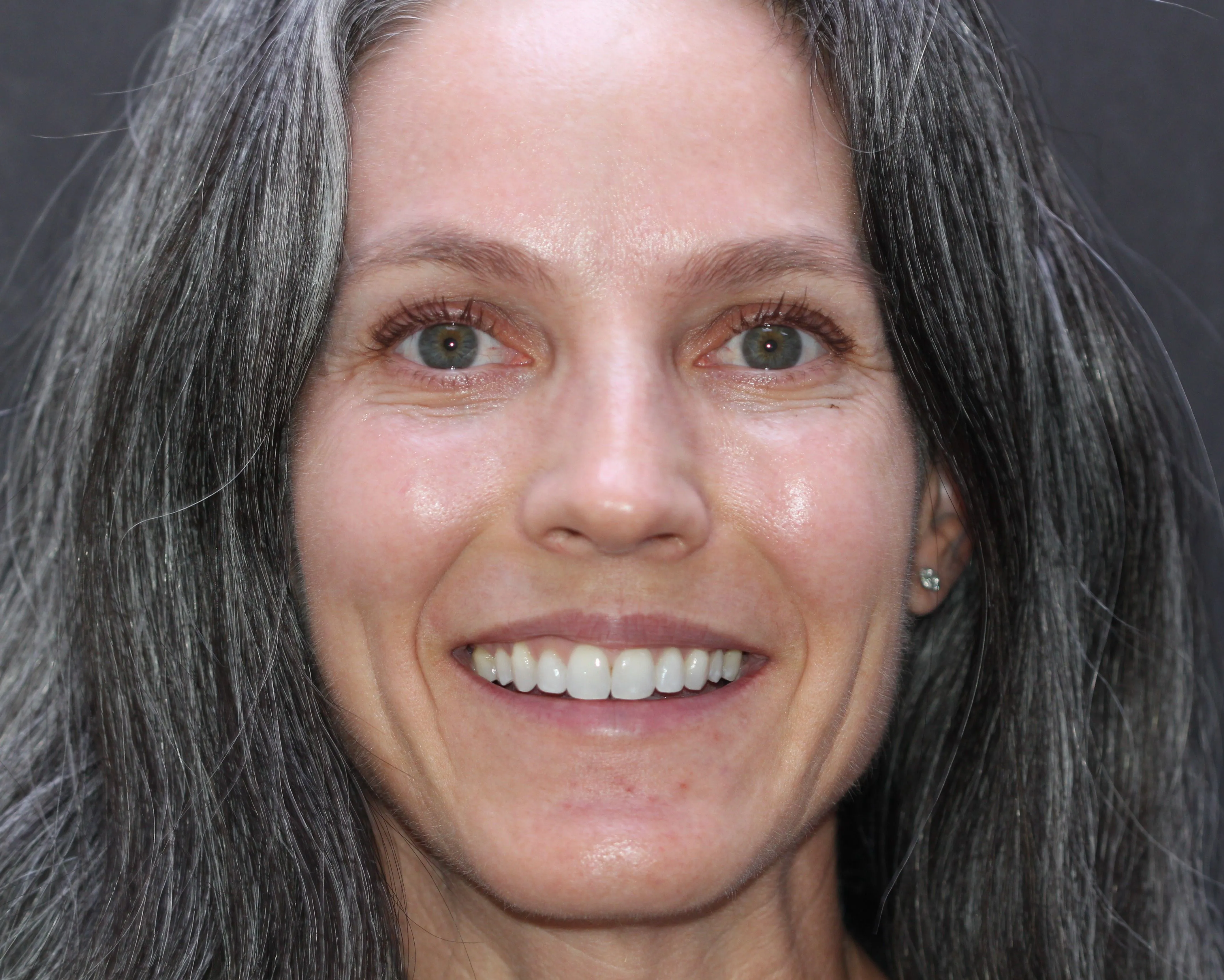 Invisalign - After