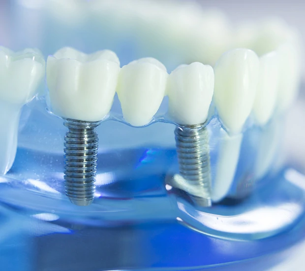 Dental implant illustration