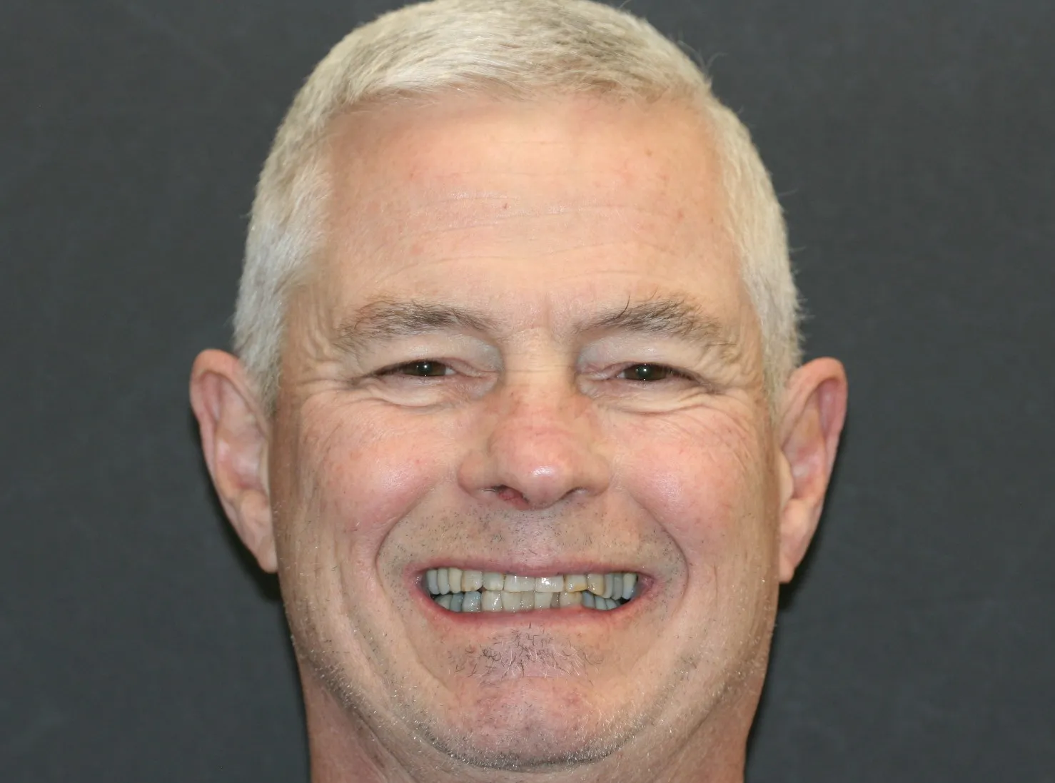 Full-Mouth Reconstruction - Before
